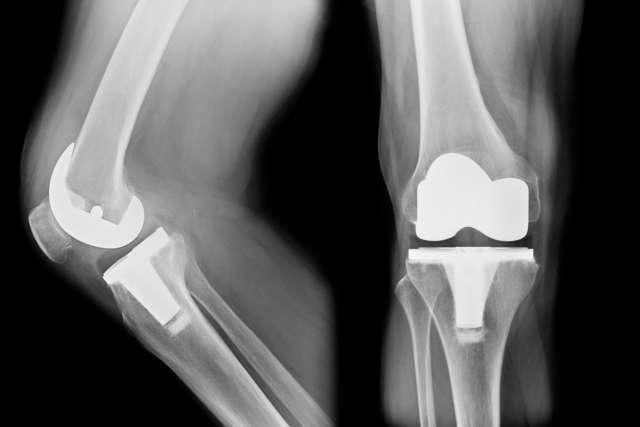TKA x线片，全膝关节置换术的正面和侧面