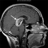 核磁共振扫描显示大脑松果体区有一个大肿瘤.
