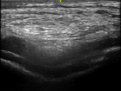 膝关节软骨内大量钙沉积的超声图像.