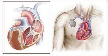 一颗心脏的图像，举例说明激光铅提取