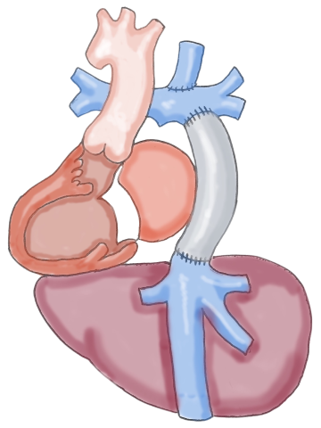 心脏和肝脏疾病 - Fontan Physiology